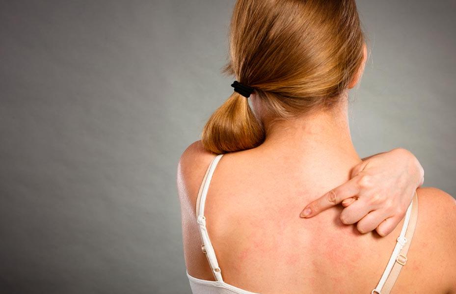 diferencia urticaria alergia